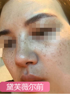 怎样才能快速把斑去掉?快速安全去斑的生活小窍门