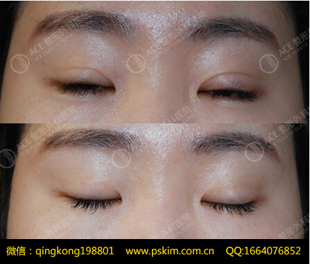双眼皮疤痕修复哪家好【韩国ACE修复医院针剂修复】