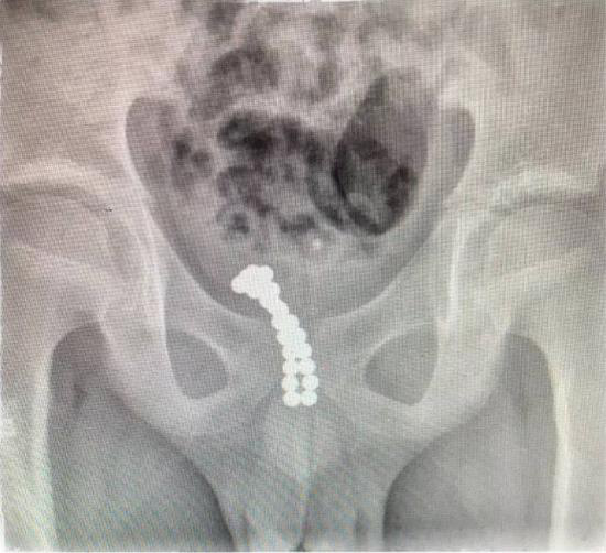 没完没了避孕套关注：为什么受伤的总是孩子?