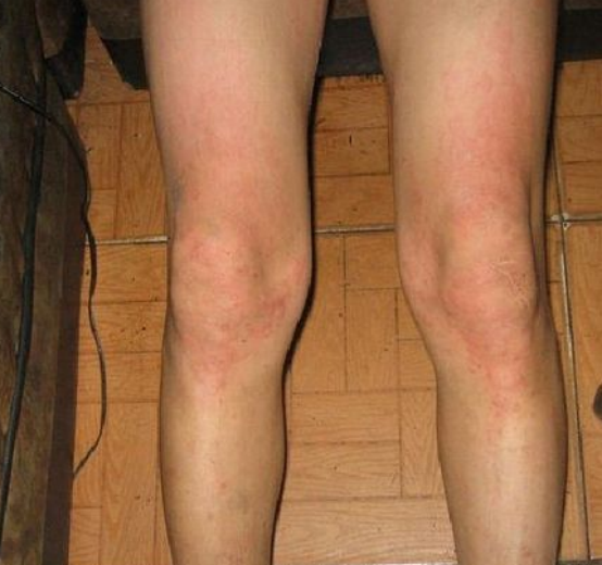 接触性皮炎如何诊断，确诊后即可快速治疗