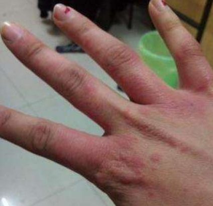 怀孕手脚起湿疹怎么办？城里人还不知道的土方法一应俱全