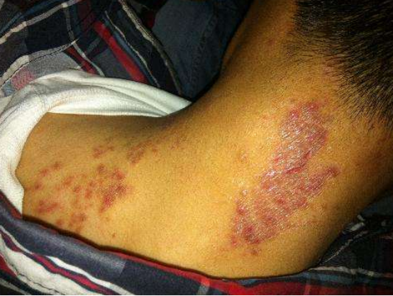 皮肤癣怎么治疗啊？中医秘方效果真不错