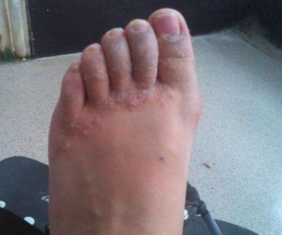 脚上起水泡是不是湿疹 一分钟就可以辨别