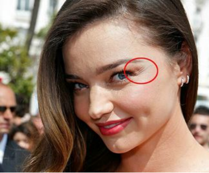 除皱针可以去除鱼尾纹吗？去除就用这六种方法