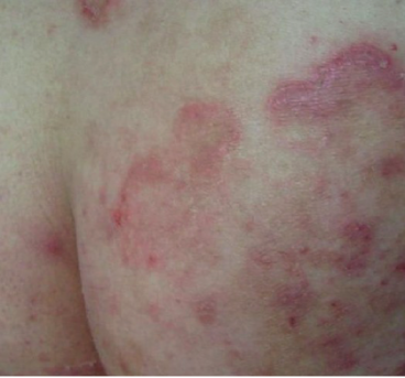 屁股上湿疹的治疗方法，帮你解决尴尬困扰