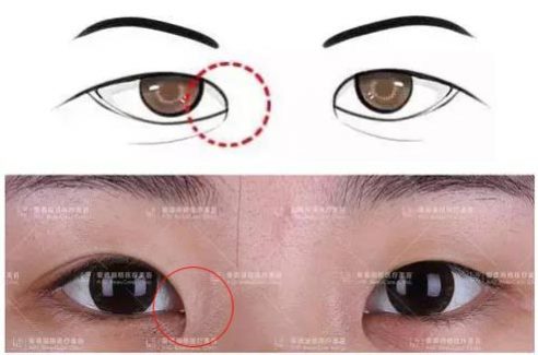 爱德丽格刘志刚小讲堂(四)：内眦赘皮与开眼角的5毛钱关系