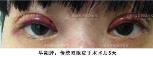 爱德丽格刘志刚小讲堂（五）：为啥做完双眼皮1年和7天一个样