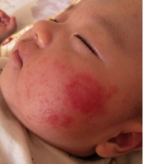 新生儿奶癣怎么治疗？打造一种全新疗法让治愈更简单