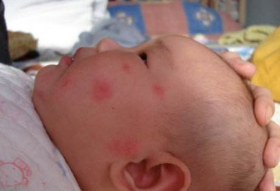新生儿起湿疹怎么办,看了这个出乎你的意料