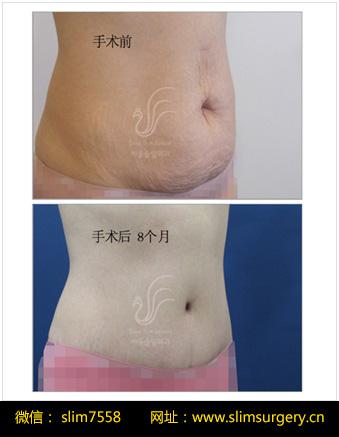 首尔slim外科-腹壁整形选择好的医院，才能有效解决产后肚皮下垂