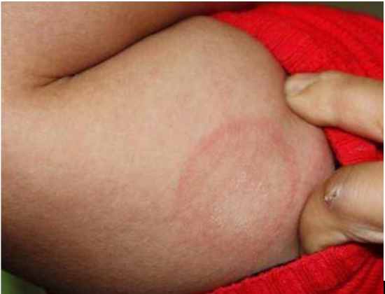 铜钱癣好治吗，只有这样做才是对的！