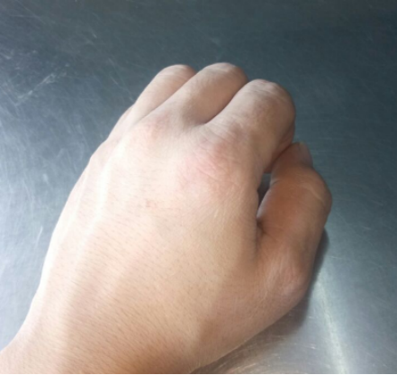 手上起皮炎湿疹什么原因？在这里让你分分钟了解