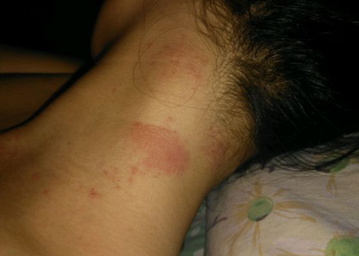 皮炎湿疹怎么治疗，从三方面彻底击破顽疾