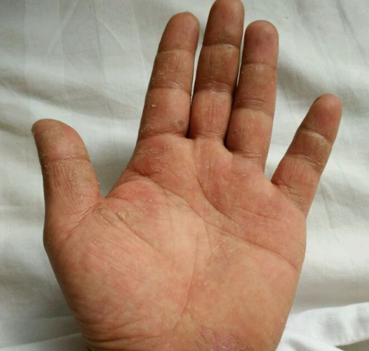 手癣怎么办  这种方法拯救了千千万万的患者