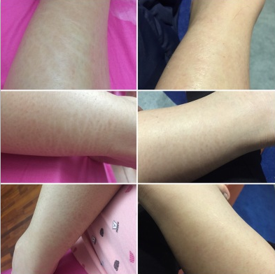 鱼鳞皮肤病会遗传吗，98%的人都这样应对