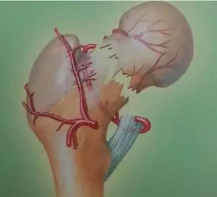 通络生骨：哪些症状预示股骨头坏死明显好转？