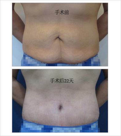 腹部下垂、皮肤松弛，靠运动就能解决？首尔slim外科告诉你！