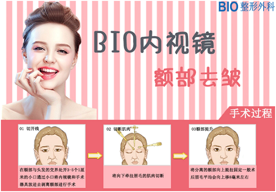 额头皱纹的克星—额部内视镜提升术