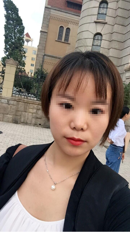 青岛伊美尔线雕鼻综合真的名不虚传 给大家讲述一下我的隆鼻经历