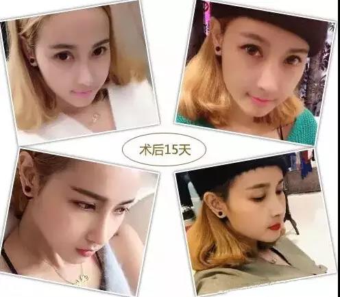 北京美莱解疑答惑：一篇文章解开你对隆鼻的心结