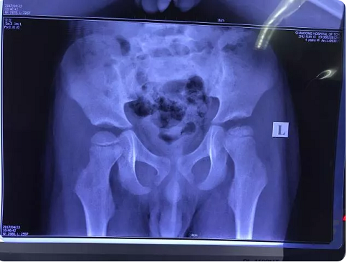 薛远亮:治愈儿童股骨头坏死 家长任重而道远